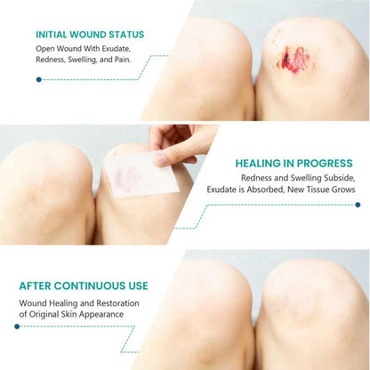 Medical-Grade Hydrocolloid Roll for Wound Care