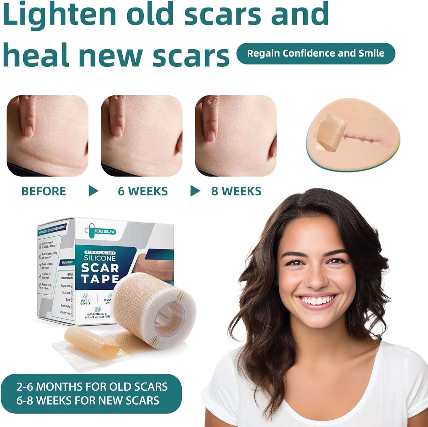 Silicone Scar Tape for Surgical Scars-1.5M