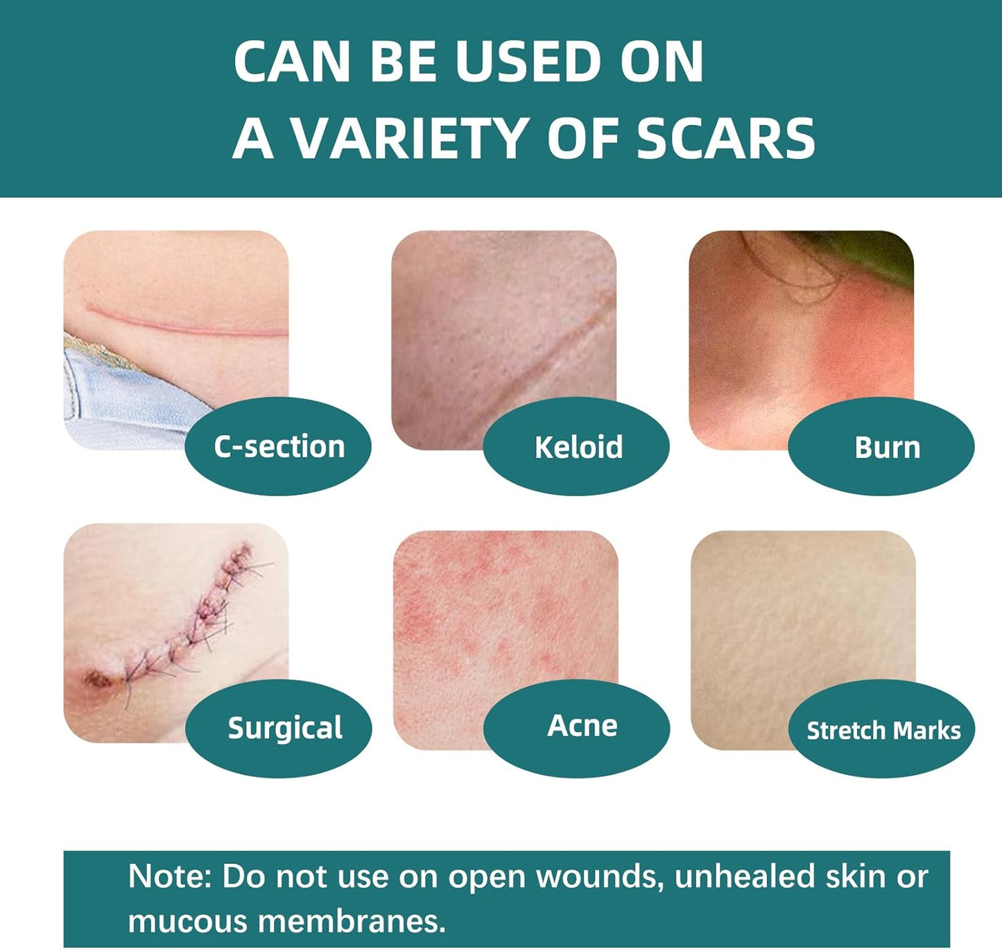 Silicone Scar Tape for Surgical Scars-3M